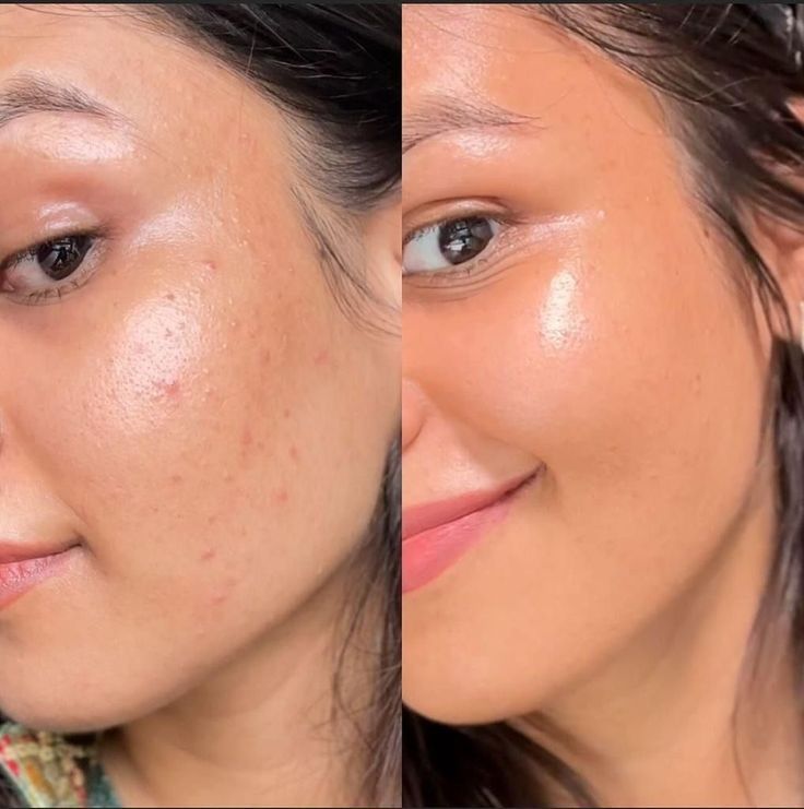 The Ordinary – Niacinamide 10% + Zinc 1% (30ml)