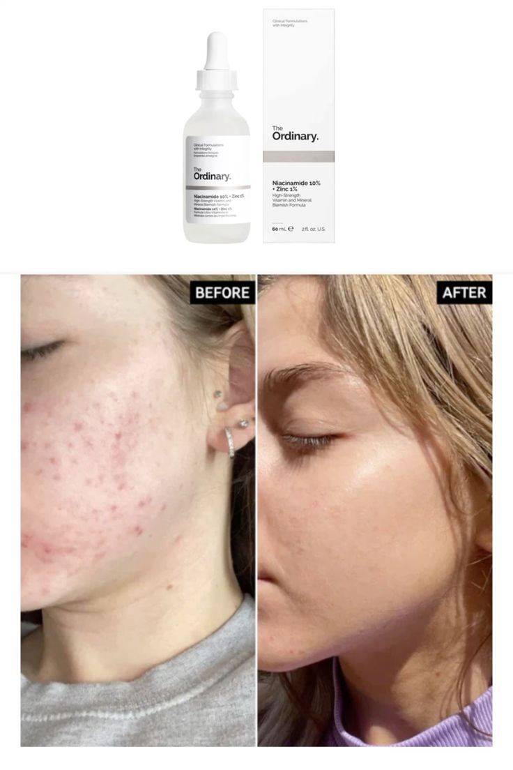 The Ordinary – Niacinamide 10% + Zinc 1% (30ml)