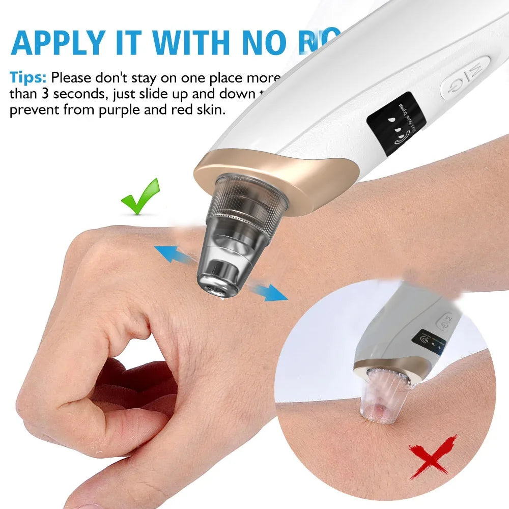 Upgraded Blackhead Remover Vacuum