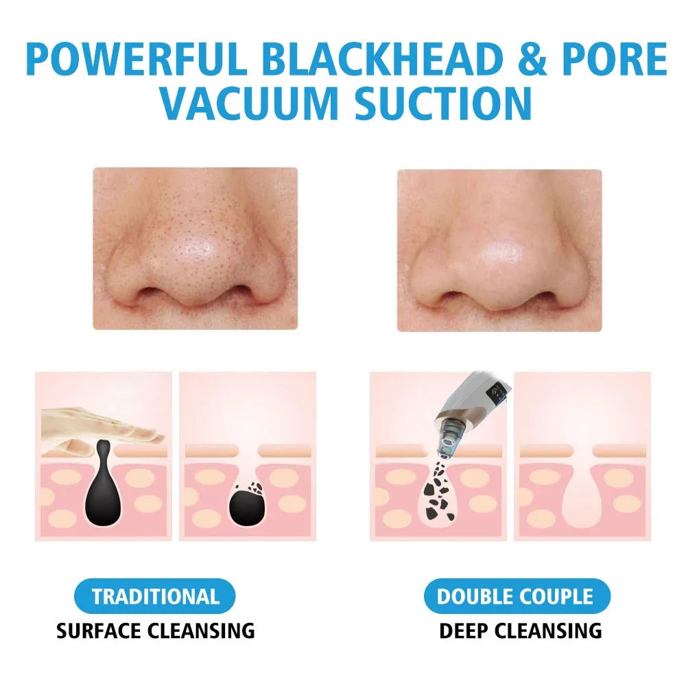 Upgraded Blackhead Remover Vacuum