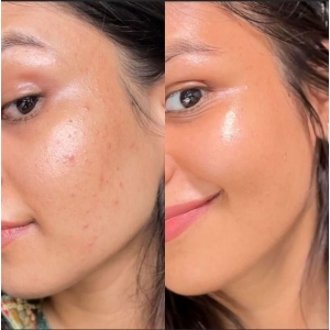 The Ordinary – Niacinamide 10% + Zinc 1% (30ml)